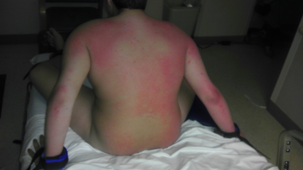 Rashes2